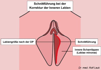 Labien vergrößerte Ein Lippenbekenntnis